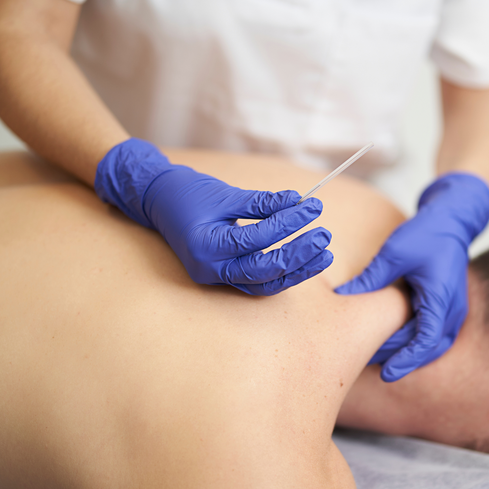 Dry Needling Therapy